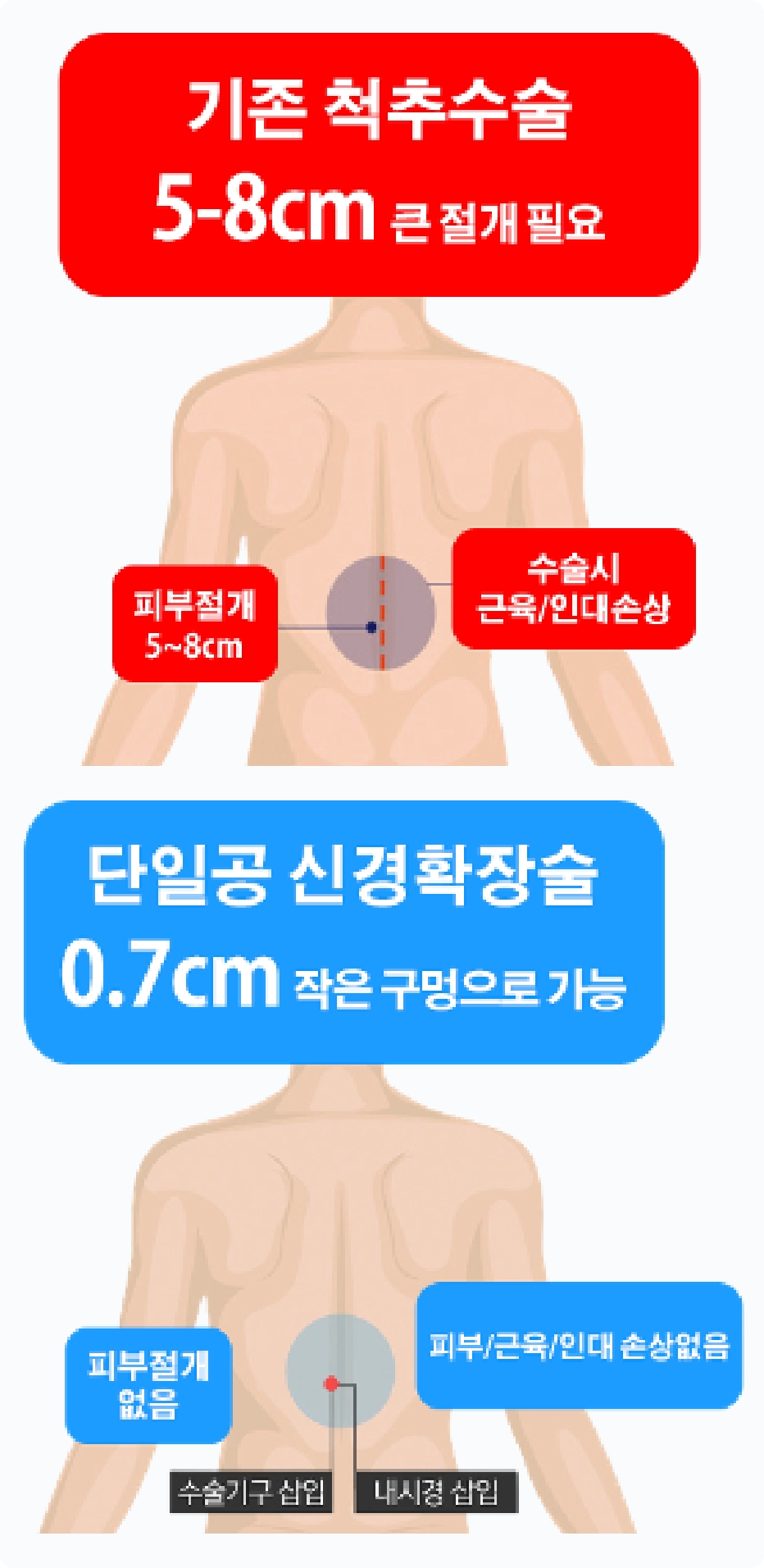 단일공내시경 허리질환