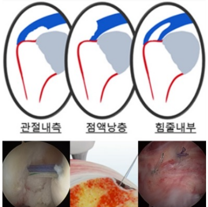 최소 침습 봉합