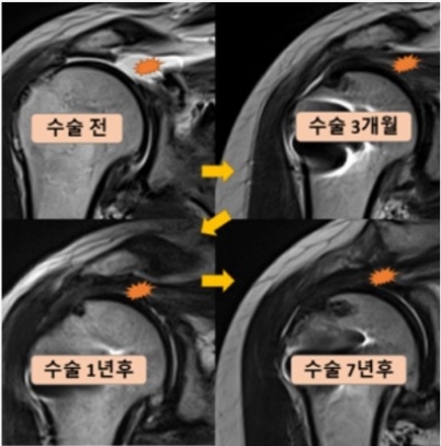 회전근개파열수술