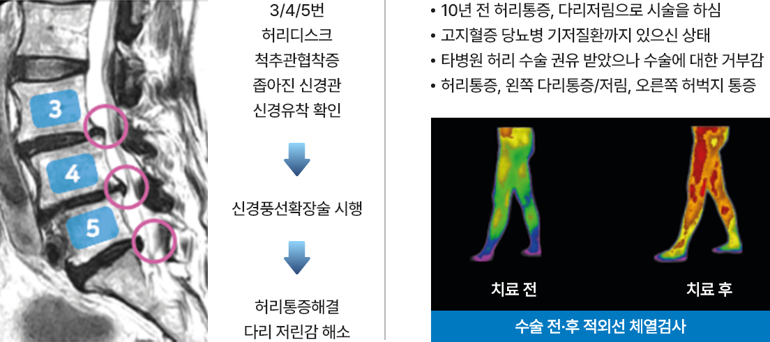 신경풍선확장술 예시