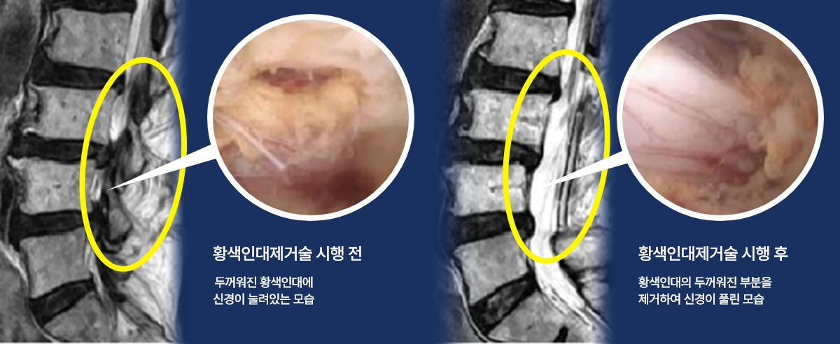 황식인대제거술 시행 전후